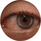 Corneal arcus